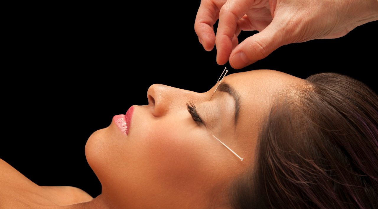 Young woman getting acupuncture treatment for health and beauty --- Image by © Becky Yee/Corbis